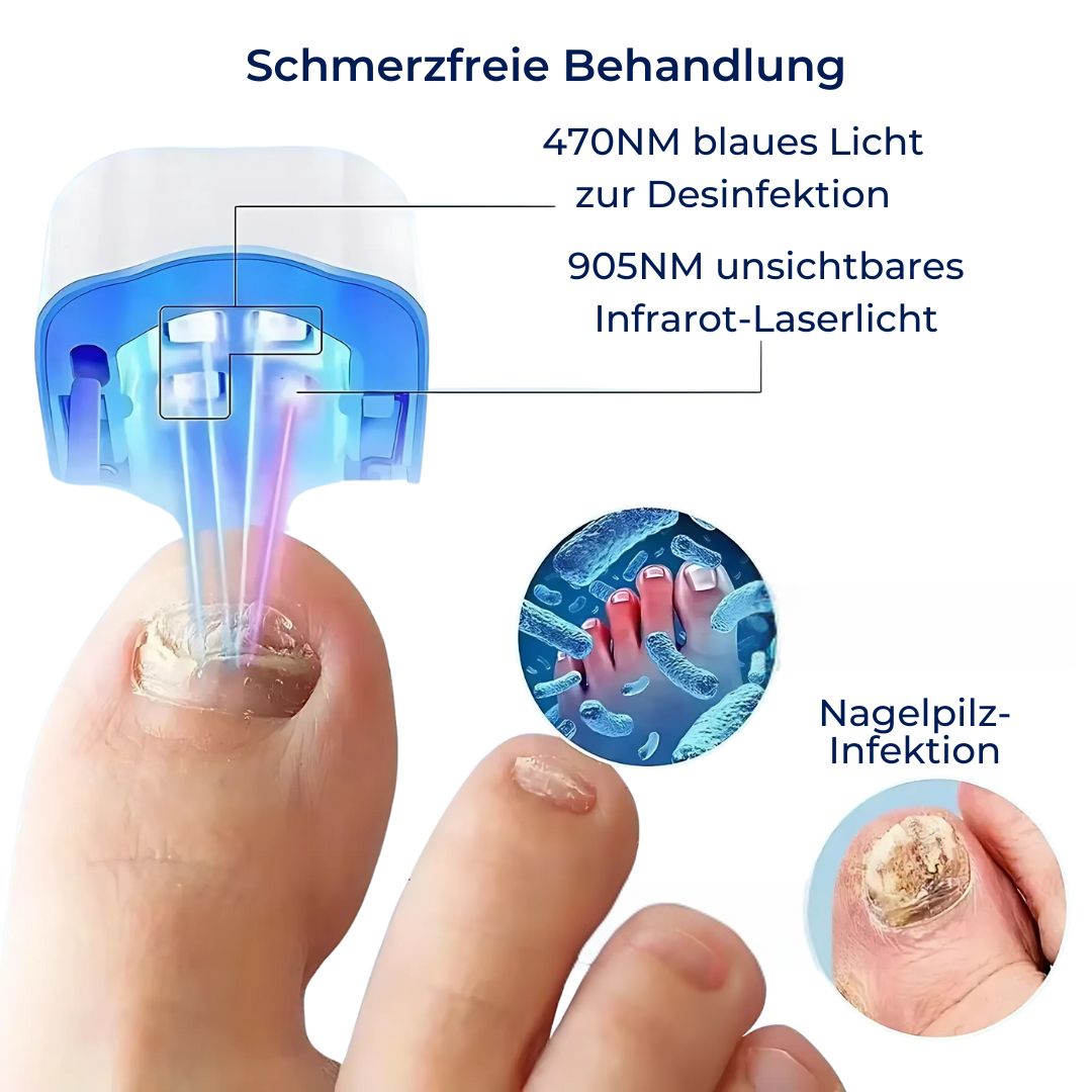 Appareil laser anti-mycose des ongles sans douleur et efficace
