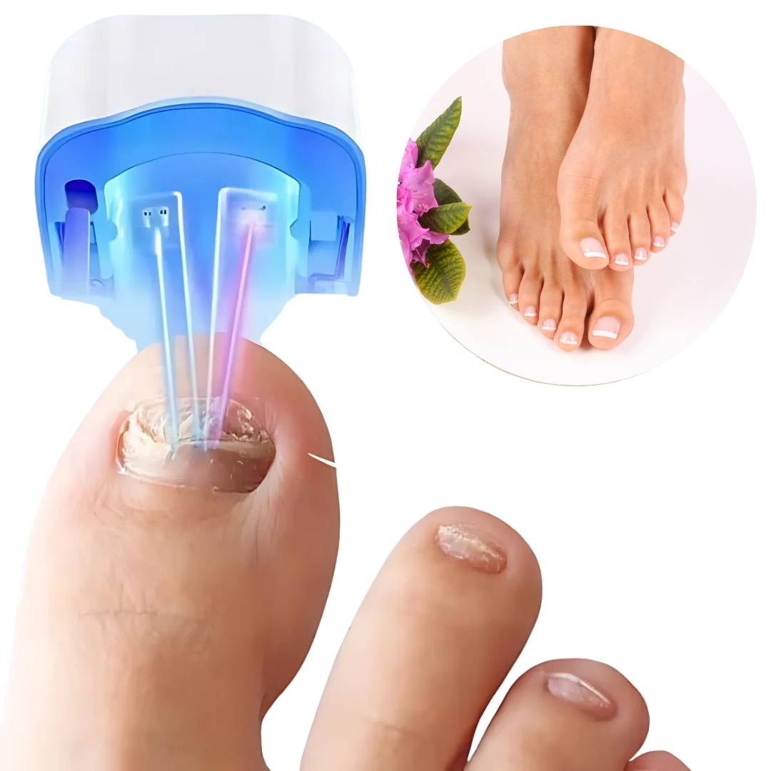 Appareil laser anti-mycose des ongles sans douleur et efficace