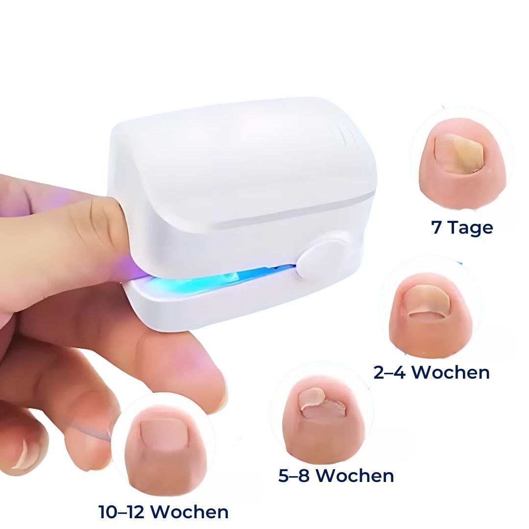 Appareil laser anti-mycose des ongles sans douleur et efficace