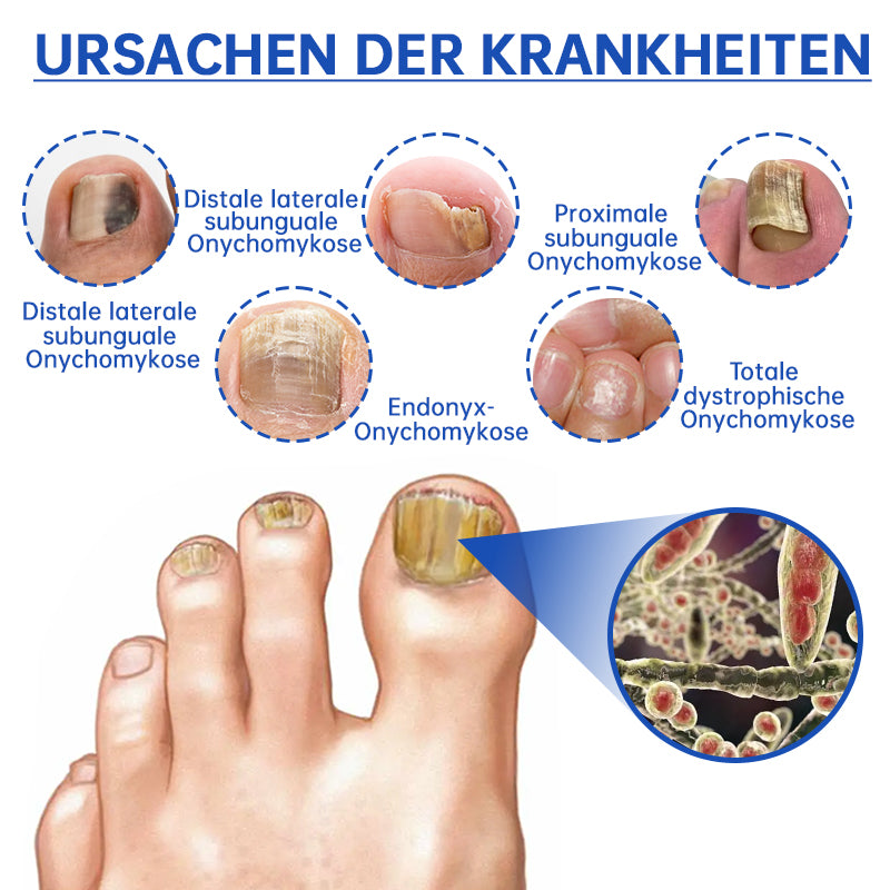 NailCure™ - Nail Fungus Laser Treatment Solution (50% DISCOUNT)