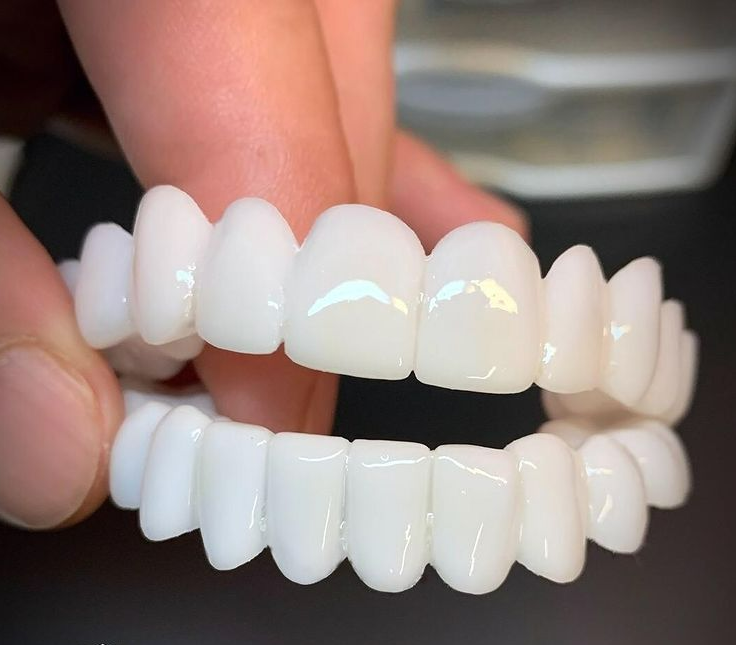 Olvoria | DentAlign Dental Veneers – Natural Fit and Comfort