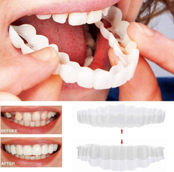 Olvoria | On Smile Veneers (Upper and Lower Jaw included)