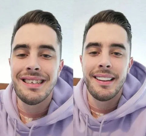 Olvoria | On Smile Veneers (Upper and Lower Jaw included)