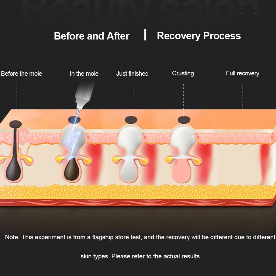 Plasma Pen Skin Tag Remover