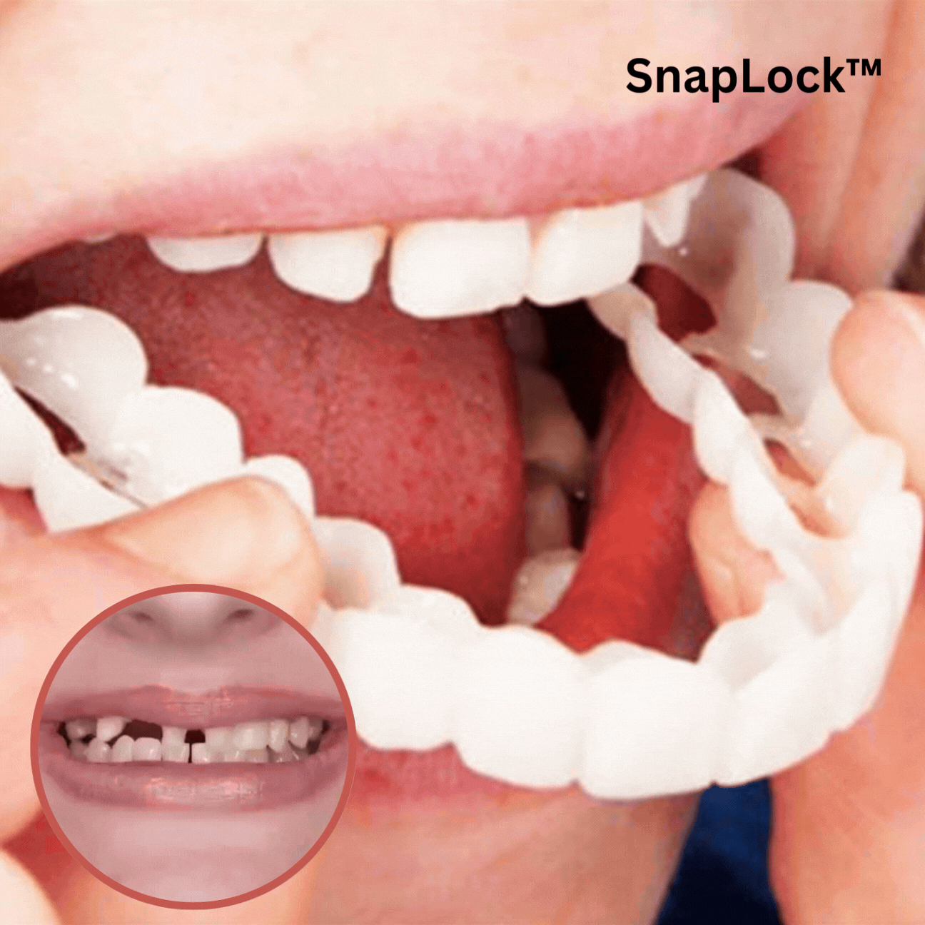 Prothèse dentaire clipsable - Sourire parfait