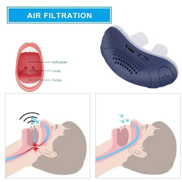 Sleepless, Maskless, Micro-CPAP Anti-Snoring