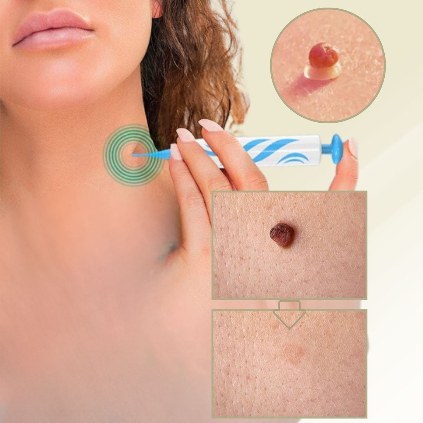 Stylo pour l'élimination des verrues et des grains de beauté sans douleur à domicile