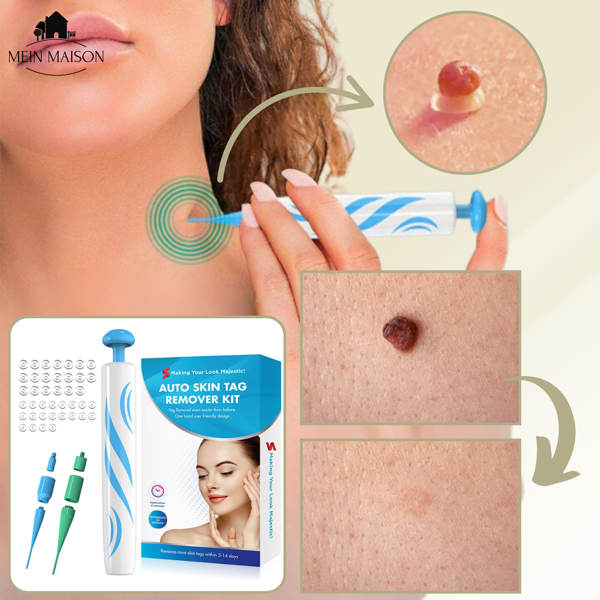Stylo pour l'élimination des verrues et des grains de beauté sans douleur à domicile